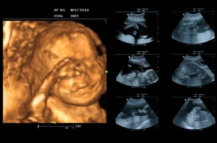 3D/4D/5D Ultrasound Scan