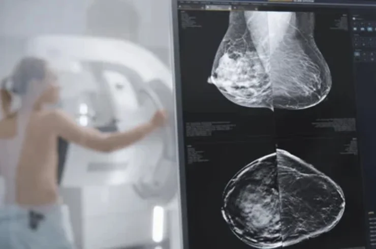 Digital Mammography